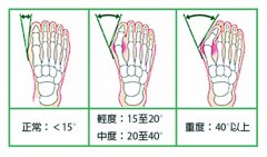 拇趾外翻的处理与治疗