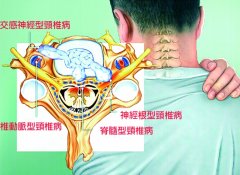 认识交感型颈椎病危害