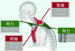 认识拉筋解开误区