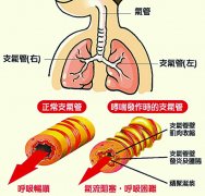 哮喘不可怕