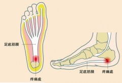 足底筋膜炎物理治疗