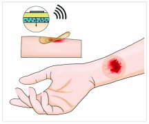 智能胶布可加速伤口癒合癒合不留疤